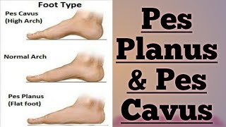 FOOT ABNORMALITIES  PES PLANUS amp PES CAVUS  👍 [upl. by Neivad]