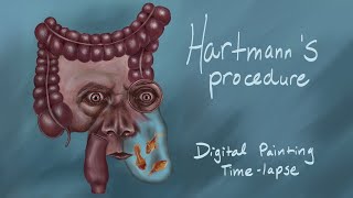 Hartmanns Procedure  Digital Painting Timelapse [upl. by Clarabelle]