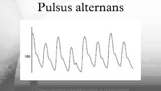 Pulsus alternans [upl. by Oba]