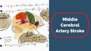 Middle Cerebral Artery Stroke [upl. by Colwin]