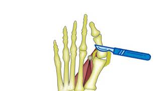 Hallux Valgus Bunion Deformity Correction SURGICAL TECHNIQUE ENG [upl. by Stephannie411]