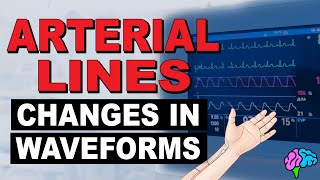 Common Changes in Arterial Line Waveforms [upl. by Odnuges]