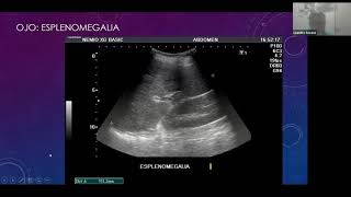 Ecografia Renal y vias Urinarias [upl. by Sihonn]