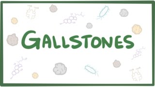 Gallstones cholelithiasis [upl. by Ynnavoig]