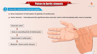 PULSES IN AORTIC STENOSIS  Usmle Cardiology [upl. by Caundra]