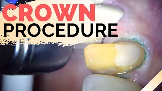 Dental Crown Explained  Anterior Crown Preparation [upl. by Starlin]