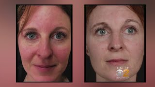 Health Watch New Laser Treatment For Rosacea [upl. by Wilhelmina61]