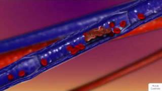 How Blood Clots Form [upl. by Otit]