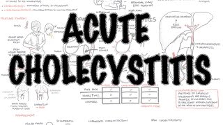 Acute Cholecystitis Imaging  Effervescent Gallbladder [upl. by Ogilvy661]