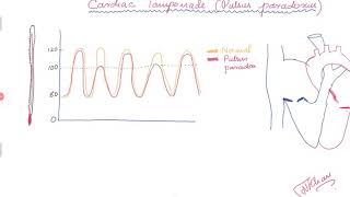 Cardiac Tamponade and Pulsus paradoxus [upl. by Jobey]