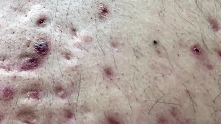 How To Remove Blackheads And Whiteheads On Back ✦ Dr Laelia ✦ [upl. by Avner]