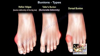 Bunions Types  Everything You Need To Know  Dr Nabil Ebraheim [upl. by Afra]