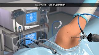 DualWave™ Pump Operation [upl. by Fariss]