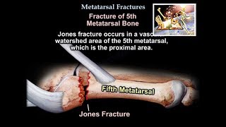 Metatarsal Fractures  Everything You Need To Know  Dr Nabil Ebraheim [upl. by Ileane871]