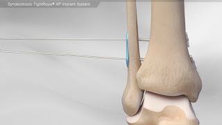 Syndesmosis TightRope® XP Implant System [upl. by Lody]