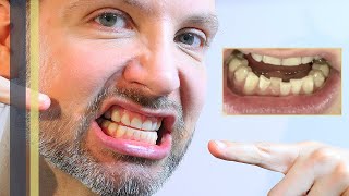 ZÄHNE WIEDER SCHIEF – NUR 2 JAHRE NACH DR SMILE  INVISALIGN ZAHNKORREKTUR – GREY YOUNG [upl. by Kenzi]