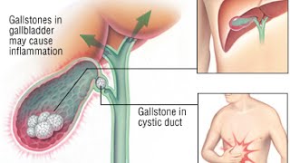 Cholecystitis [upl. by Gauldin193]