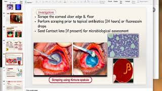 Bacterial Keratitis Part 2 [upl. by Olraced865]