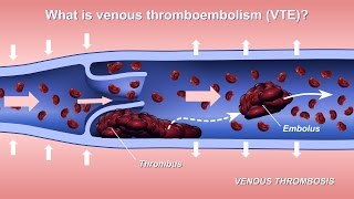 Understanding and Diagnosing Venous Thromboembolism VTE [upl. by Swee]