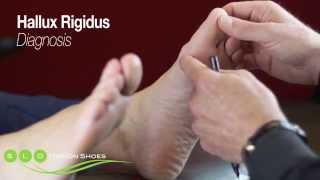 Hallux Rigidus Causes Diagnosis and Treatment [upl. by Nonregla]