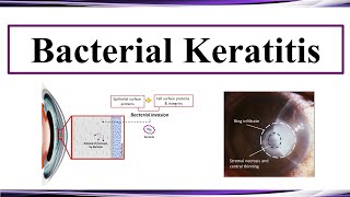 Bacterial Keratitis [upl. by Audris]