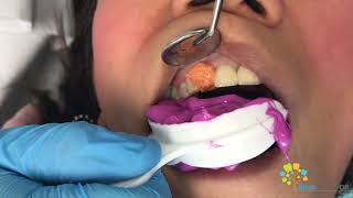 Cosmetic Dental Crown Procedure  All Ceramic Crown [upl. by Kory265]